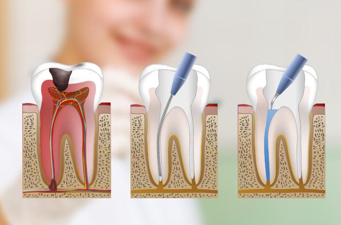 Cuánto tiempo dura el proceso de endodoncia