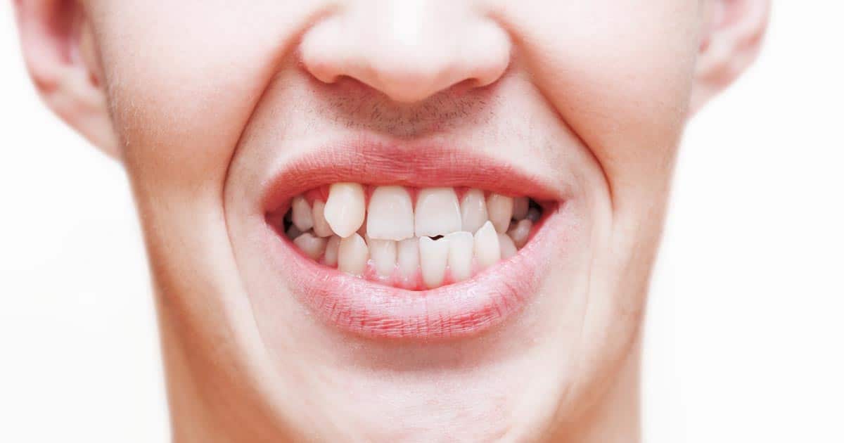 Corregir problemas dentales por hábitos perjudiciales en la infancia